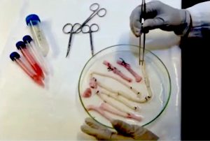 Never-before-seen rubbery white clots, pulled from the veins and arteries