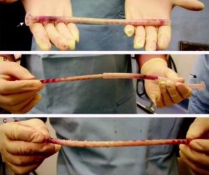 Stretchy, elastic-like white clots pulled from veins and arteries of the deceased post-vaxx.